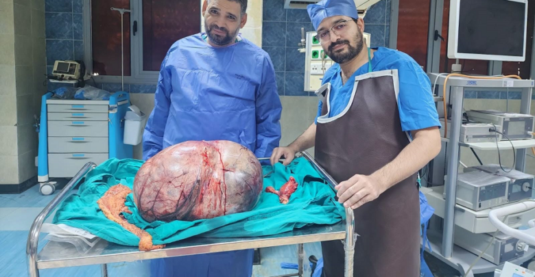 مستشفيات جامعة المنيا تنجح في استئصال ورم مبيضي نادر يزن 24 كيلوجرامًا